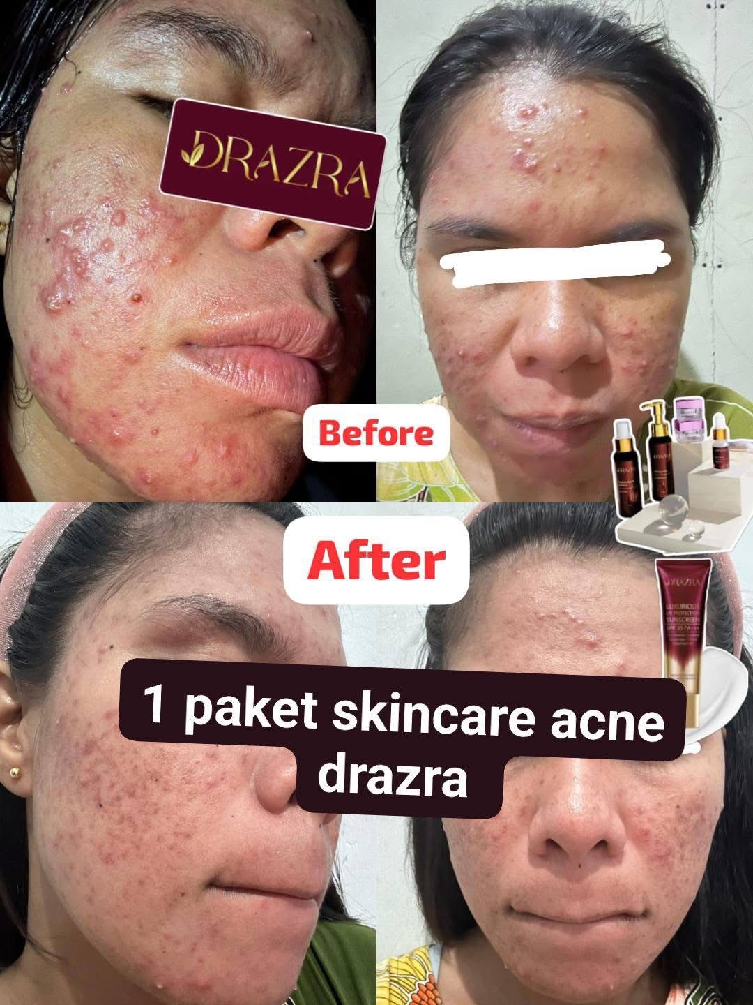 Testimoni before after skincare acne DRAZRA