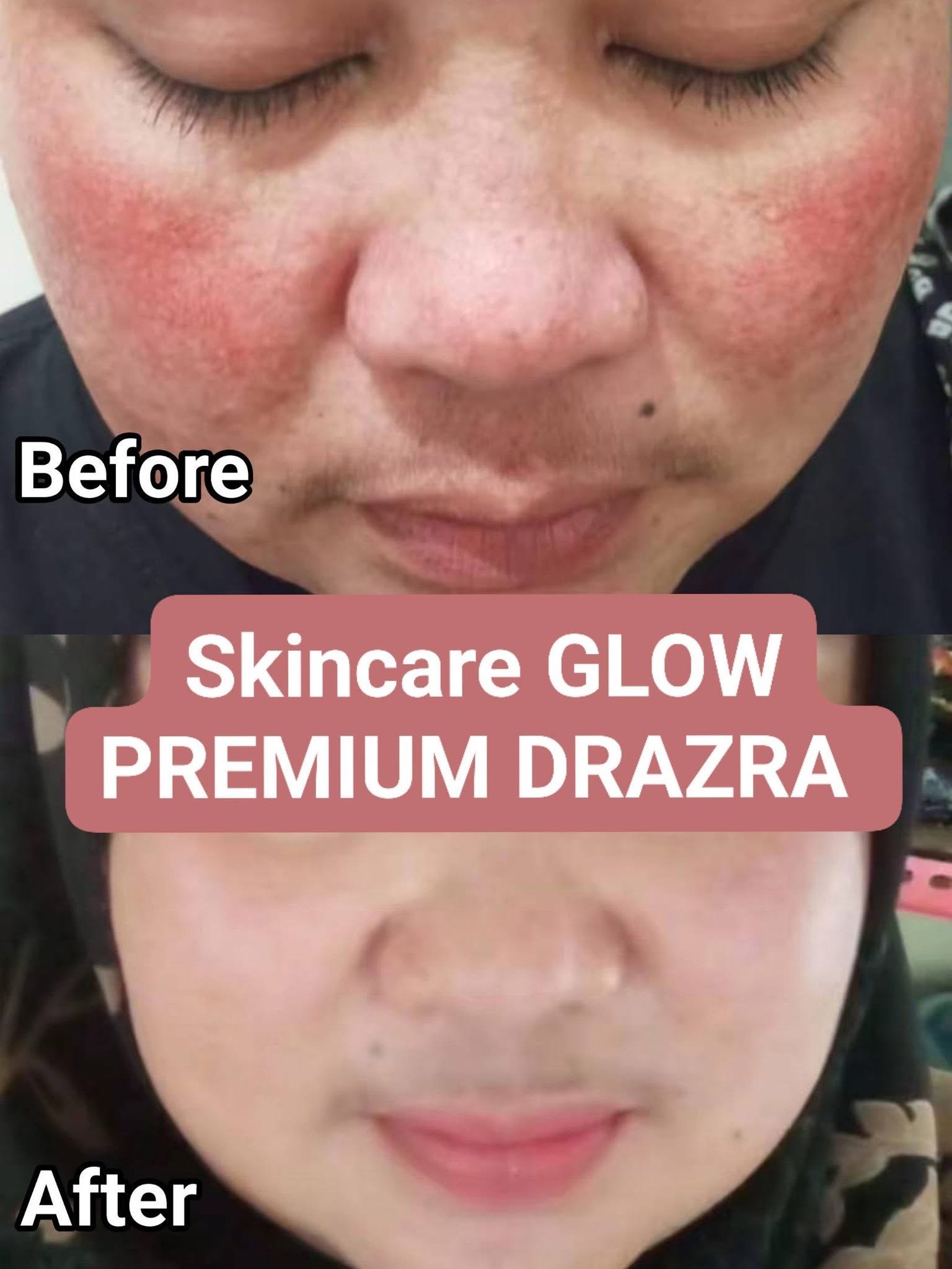 Testimoni before after skincare Glow Premium DRAZRA