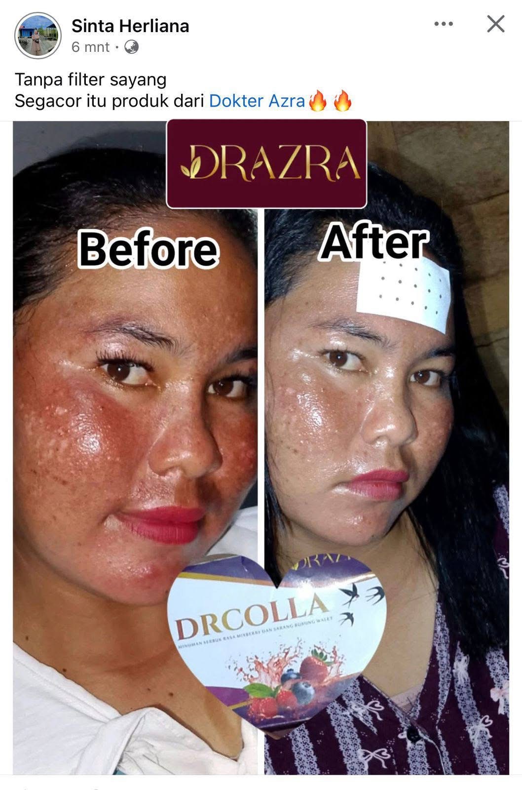Testimoni before after DRAZRA dan DRCOLLA