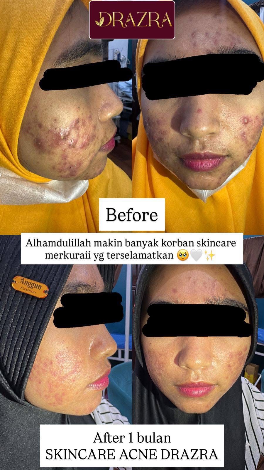 Testimoni before after skincare acne DRAZRA satu bulan