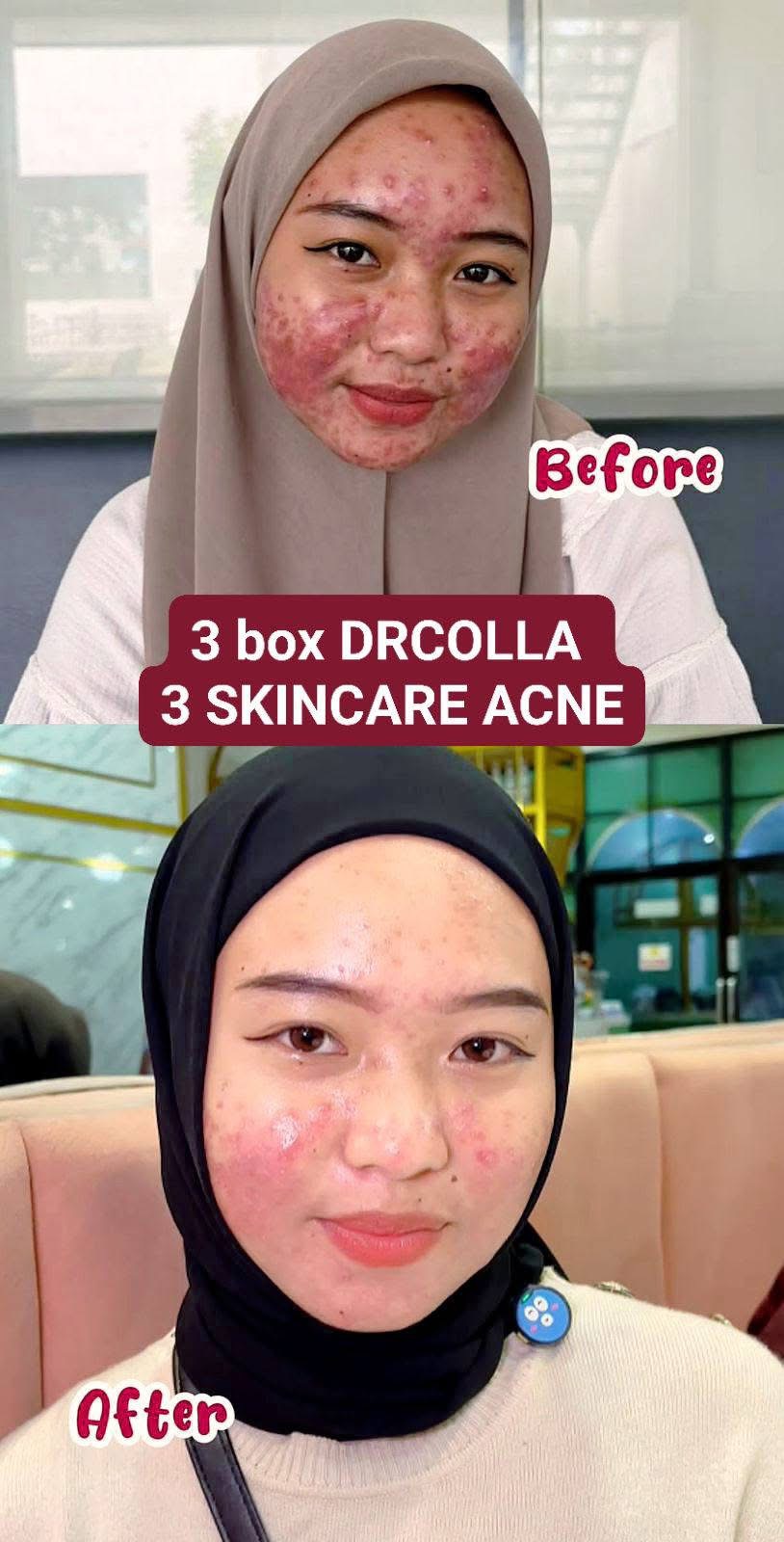 Testimoni DRCOLLA dan skincare acne DRAZRA